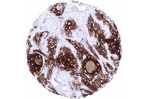 Strong Cytokeratin 10 immunostaining in a squamous cell carcinoma of the vulva. (Recombinant Keratin 10 antibody)