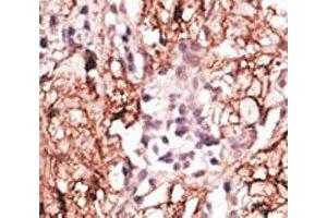 IHC analysis of FFPE human breast carcinoma tissue stained with the LSD1 antibody (LSD1 antibody  (AA 108-142))