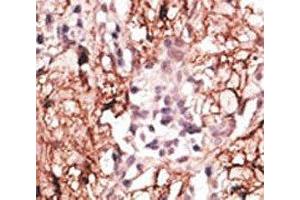 IHC analysis of FFPE human breast carcinoma tissue stained with the LSD1 antibody