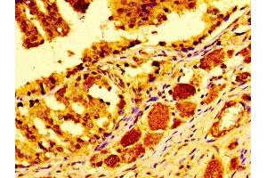 Immunohistochemistry of paraffin-embedded human prostate cancer using ABIN7147000 at dilution of 1:100 (Cathepsin D antibody  (AA 67-403))