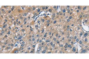 Immunohistochemistry of paraffin-embedded Human liver cancer using TRIP4 Polyclonal Antibody at dilution of 1:50 (TRIP4 antibody)