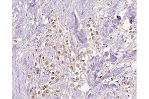ABIN6266828 at 1/100 staining human Breast cancer tissue sections by IHC-P. (VPS72 antibody  (Internal Region))