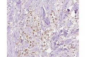 ABIN6266828 at 1/100 staining human Breast cancer tissue sections by IHC-P. (VPS72 antibody  (Internal Region))
