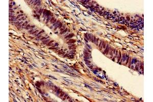 Immunohistochemistry of paraffin-embedded human colon cancer using ABIN7168530 at dilution of 1:100 (MAT2A antibody  (AA 1-395))
