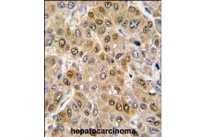 Formalin-fixed and paraffin-embedded human hepatocarcinoma tissue reacted with DDX5 antibody , which was peroxidase-conjugated to the secondary antibody, followed by DAB staining. (DDX5 antibody  (C-Term))