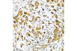 Immunohistochemistry of paraffin-embedded human gastric cancer using TAPBP Antibody (ABIN1875423) at dilution of 1:200 (40x lens). (TAPBP antibody)