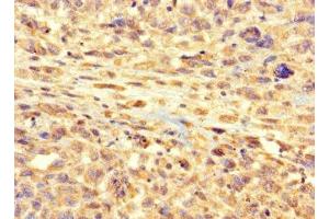 Immunohistochemistry of paraffin-embedded human melanoma using ABIN7167050 at dilution of 1:100