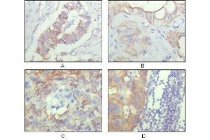 Immunohistochemical analysis of paraffin-embedded human ovary carcinoma (A), kidney carcinoma (B), lung carcinoma (C) and breast carcinoma (D), showing cytoplasmic and membrane localization with DAB staining using ALCAM antibody. (CD166 antibody  (AA 405-524))
