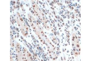 Immunohistochemistry of paraffin-embedded Human gastric cancer using ZNF433 Polyclonal Antibody at dilution of 1:100 (40x lens).