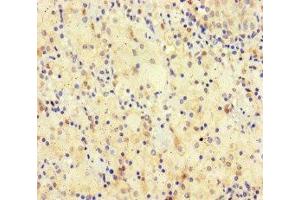 Immunohistochemistry of paraffin-embedded human lung cancer using ABIN7170512 at dilution of 1:100 (SPATA16 antibody  (AA 238-475))