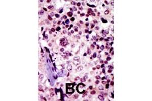 Formalin-fixed and paraffin-embedded human cancer tissue reacted with the primary antibody, which was peroxidase-conjugated to the secondary antibody, followed by AEC staining. (Protein Kinase A beta (AA 50-80), (N-Term), (Regulatory Subunit 1) antibody)