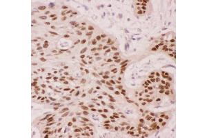 Anti-p63 Picoband antibody,  IHC(P): Human Oesophagus Squama Cancer Tissue (p63 antibody  (AA 311-680))