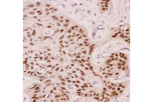 Anti-p63 Picoband antibody,  IHC(P): Human Oesophagus Squama Cancer Tissue (p63 antibody  (AA 311-680))