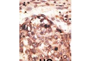 Formalin-fixed and paraffin-embedded human cancer tissue reacted with the primary antibody, which was peroxidase-conjugated to the secondary antibody, followed by AEC staining. (MMP8 antibody  (AA 286-315))
