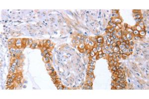 Immunohistochemistry of paraffin-embedded Human cervical cancer tissue using ABO Polyclonal Antibody at dilution 1:50 (ABO antibody)