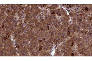 ABIN6277108 at 1/100 staining Human liver cancer tissue by IHC-P. (CD90 antibody  (Internal Region))