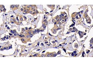 Detection of RIPK1 in Human Breast cancer Tissue using Polyclonal Antibody to Receptor Interacting Serine Threonine Kinase 1 (RIPK1) (RIPK1 antibody  (AA 17-289))