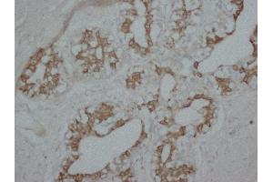 Anti-PKC alpha antibody, IHC(P) IHC(P): Human Mammary Cancer Tissue (PKC alpha antibody  (N-Term))