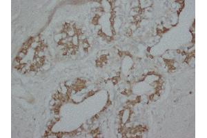 Anti-PKC alpha antibody, IHC(P) IHC(P): Human Mammary Cancer Tissue