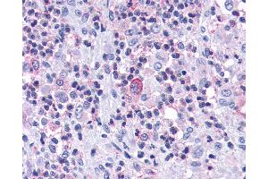 Anti-CCR7 antibody IHC of human Bone, Eosinophilic Granuloma. (CCR7 antibody  (C-Term))