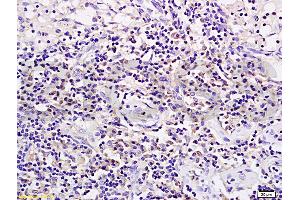 Formalin-fixed and paraffin embedded rat transplant lymphoma labeled with Anti-CD19 Polyclonal Antibody (ABIN724595), Unconjugated 1:200 followed by conjugation to the secondary antibody and DAB staining (CD19 antibody  (AA 485-556))
