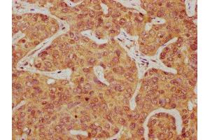 IHC image of ABIN7166569 diluted at 1:300 and staining in paraffin-embedded human liver cancer performed on a Leica BondTM system. (PCDH7 antibody  (AA 906-1032))