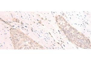 Immunohistochemistry of paraffin-embedded Human esophagus cancer tissue using TBC1D2 Polyclonal Antibody at dilution of 1:25(x200) (TBC1D2 antibody)