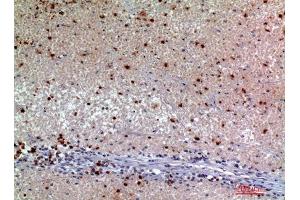 Immunohistochemistry (IHC) analysis of paraffin-embedded Human Kidney Cancer, antibody was diluted at 1:200. (SNCA antibody)