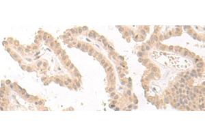 Immunohistochemistry of paraffin-embedded Human thyroid cancer tissue using PBXIP1 Polyclonal Antibody at dilution of 1:40(x200)