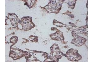 Immunohistochemistry of paraffin-embedded human colon cancer using ABIN7156785 at dilution of 1:100 (IL12B antibody  (AA 23-328))