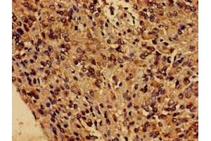 Immunohistochemistry of paraffin-embedded human glioma using ABIN7153243 at dilution of 1:100