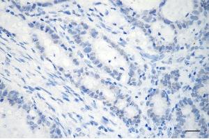 Immunohistochemistry was performed on paraffin-embedded human sigmoid colon carcinoma using GTF2I antibody (ABIN7798709), 1:200).