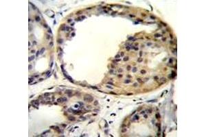 AKT1 antibody immunohistochemistry analysis in formalin fixed and paraffin embedded human breast carcinoma (AKT1 antibody  (AA 282-309))