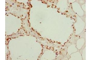 Immunohistochemistry of paraffin-embedded human breast cancer using ABIN7153448 at dilution of 1:100 (LGALS12 antibody  (AA 1-336))