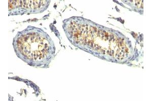 Formalin-fixed, paraffin-embedded human Testicular Carcinoma stained with TGF alpha Monoclonal Antibody (P/T1) (TGFA antibody  (AA 34-43))