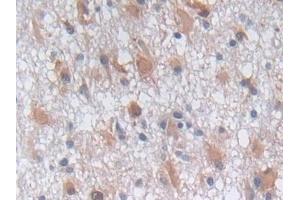 Detection of PGK1 in Human Glioma Tissue using Polyclonal Antibody to Phosphoglycerate Kinase 1 (PGK1)