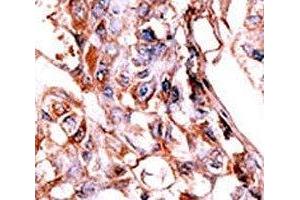 IHC analysis of FFPE human hepatocarcinoma tissue stained with the phospho-HER4 antibody. (ERBB4 antibody  (pTyr1188))