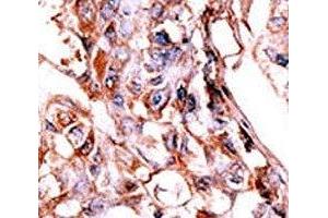 IHC analysis of FFPE human hepatocarcinoma tissue stained with the phospho-HER4 antibody.