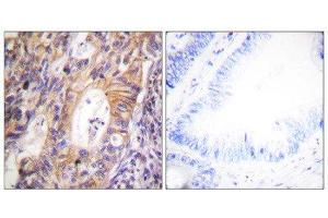 Immunohistochemistry (IHC) image for anti-Met Proto-Oncogene (MET) (pTyr1003) antibody (ABIN1847353) (c-MET antibody  (pTyr1003))