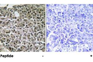 Immunohistochemical analysis of paraffin-embedded human breast carcinoma tissue using NFATC4 polyclonal antibody . (NFATC4 antibody)