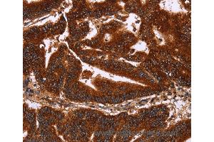 Immunohistochemistry of Human gastric cancer using GCKR Polyclonal Antibody at dilution of 1:50