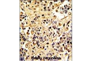 Formalin-fixed and paraffin-embedded human kidney carcinoma with Neprilysin Antibody (C-term), which was peroxidase-conjugated to the secondary antibody, followed by DAB staining. (MME antibody  (C-Term))