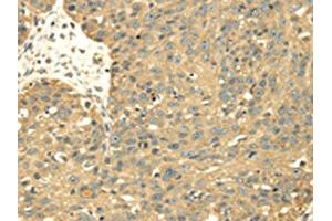 The image on the left is immunohistochemistry of paraffin-embedded Human breast cancer tissue using ABIN7128021(SRPRB Antibody) at dilution 1/30, on the right is treated with fusion protein. (SRPRB antibody)