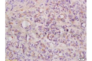 Formalin-fixed and paraffin embedded mouse tumor tissue labeled with Anti ANGPT3/ANG3/ANGPT4/ANG4 Polyclonal Antibody,Unconjugated (ABIN737466) at 1:200 followed by conjugation to the secondary antibody and DAB staining. (Angiopoietin 4 antibody  (AA 410-503))