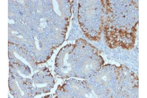 Formalin-fixed, paraffin-embedded human Colon Carcinoma stained with ATG5 Mouse Monoclonal Antibody (ATG5/2492). (ATG5 antibody  (AA 1-119))