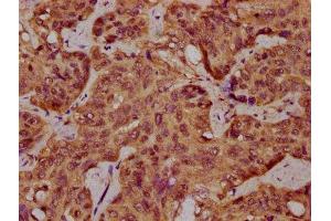 IHC image of ABIN7168937 diluted at 1:400 and staining in paraffin-embedded human liver cancer performed on a Leica BondTM system. (SPINK9 antibody  (AA 20-86))