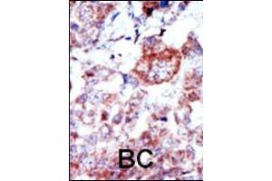 Formalin-fixed and paraffin-embedded human cancer tissue reacted with the primary antibody, which was peroxidase-conjugated to the secondary antibody, followed by AEC staining. (ILK antibody  (N-Term))