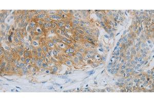Immunohistochemistry of paraffin-embedded Human esophagus cancer using NDRG1 Polyclonal Antibody at dilution of 1:70 (NDRG1 antibody)