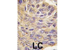 Formalin-fixed and paraffin-embedded human lung carcinoma tissue reacted with PTPN9 polyclonal antibody  , which was peroxidase-conjugated to the secondary antibody, followed by DAB staining.