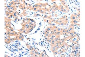 The image on the left is immunohistochemistry of paraffin-embedded Human lung cancer tissue using ABIN7128186(ACSM5 Antibody) at dilution 1/35, on the right is treated with fusion protein. (ACSM5 antibody)